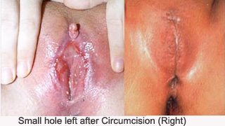 Female-Genital-Mutilation-circumcision